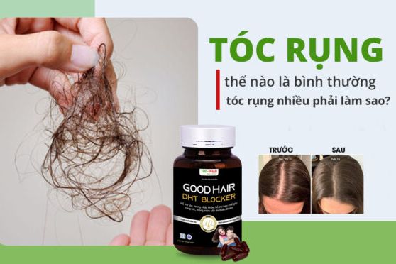 Ngăn ngừa rụng tóc cùng với Innovative Shampoo to prevent Hair Loss